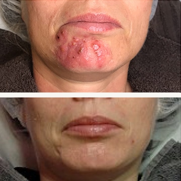 Acne/akne (uren hud) Før og efter billede