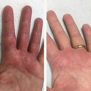 eksem (Før & efter billede)