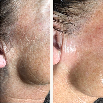 Hårfjerning med epilering og release peel