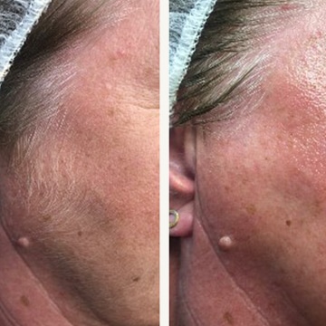 Hårfjerning med epilering og release peel