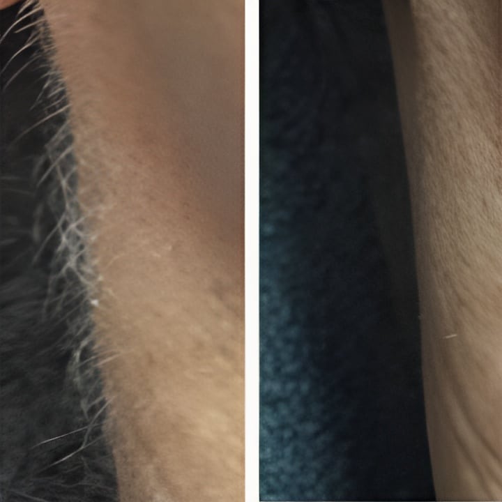 Hårfjerning med epilering og release peel