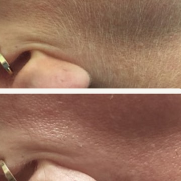 Hårfjerning med epilering og release peel
