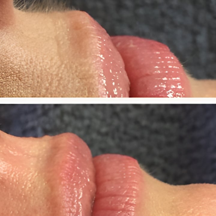 Hårfjerning med epilering og release peel