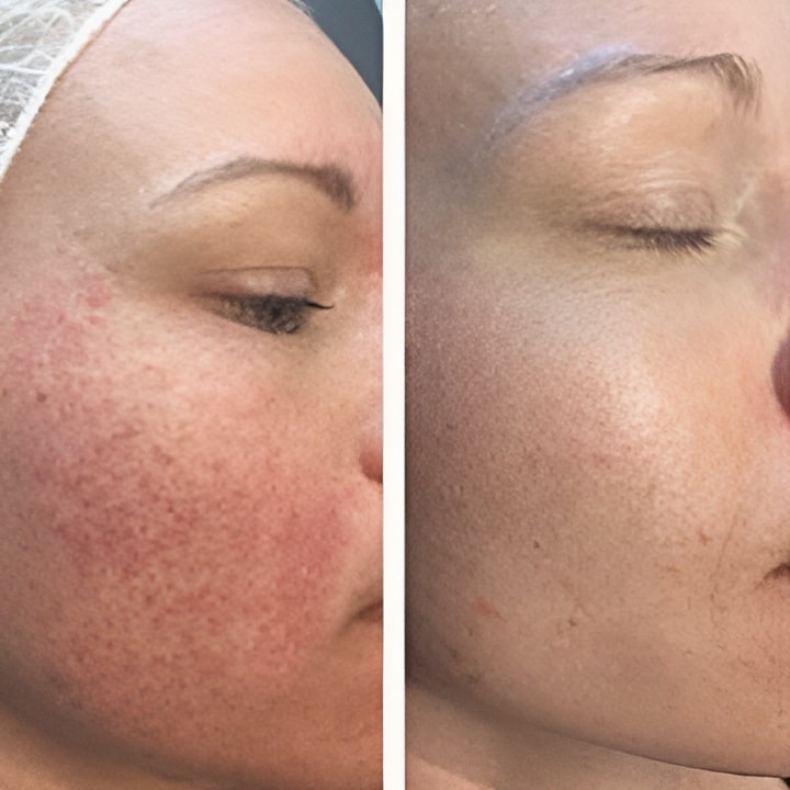 Perioral dermatitis - før & efter Behandlingsforløb
