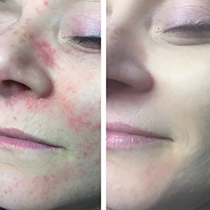 Perioral dermatitis - før & efter Behandlingsforløb