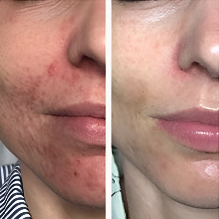 Perioral dermatitis - før & efter Behandlingsforløb