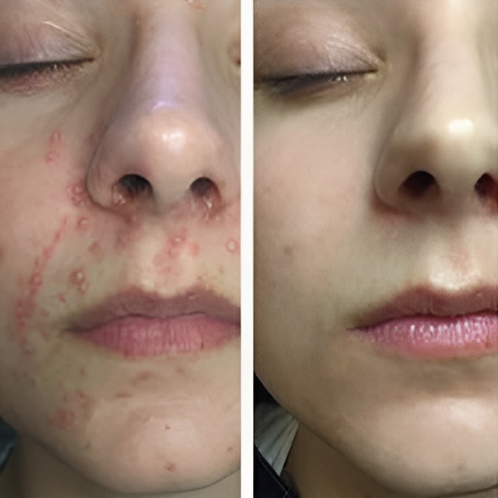 Perioral dermatitis - før & efter Behandlingsforløb