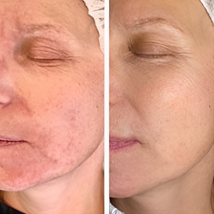 Perioral dermatitis - før & efter Behandlingsforløb