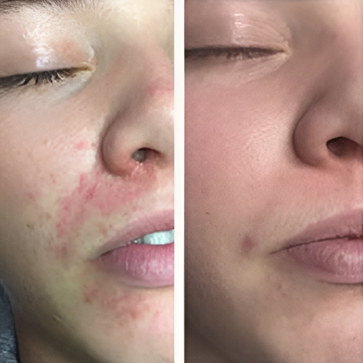 Perioral dermatitis - før & efter Behandlingsforløb