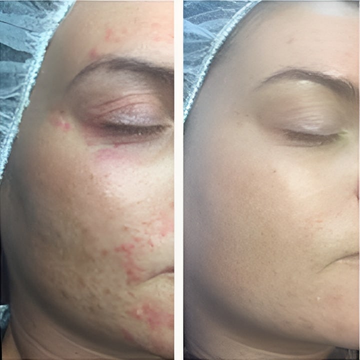 Perioral dermatitis - før & efter Behandlingsforløb