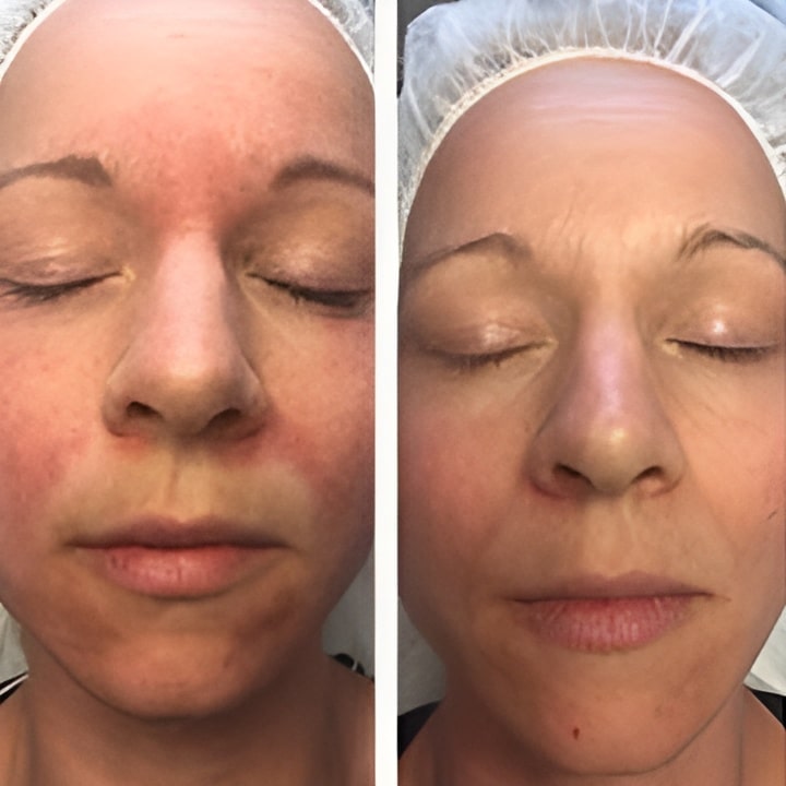 Behandling af Perioral dermatitis