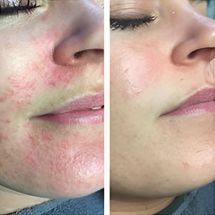 Behandling af Perioral dermatitis