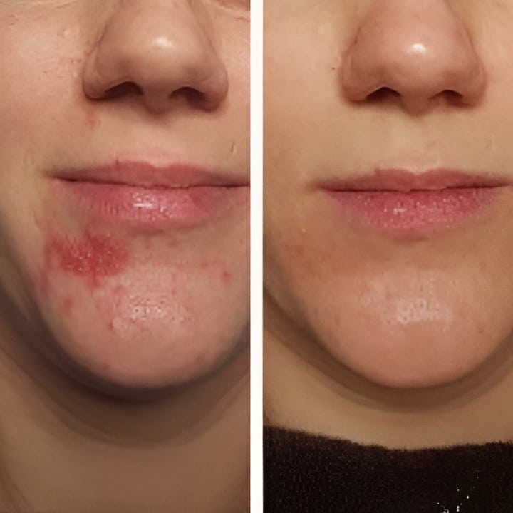 Perioral dermatitis - før & efter Behandlingsforløb