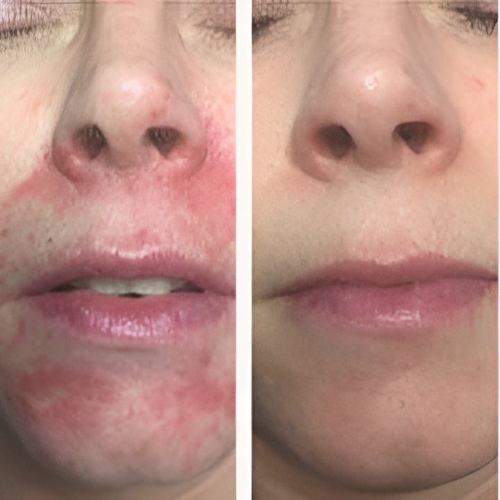 Behandling af Perioral dermatitis