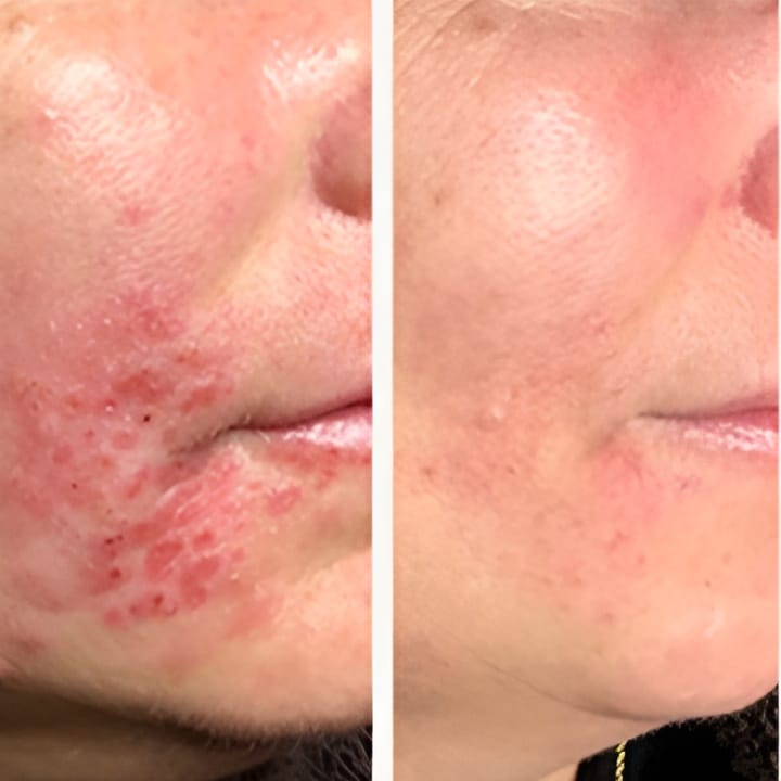 Behandling af Perioral dermatitis