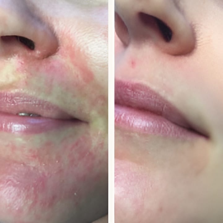 Behandling af Perioral dermatitis