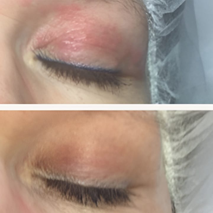 Behandling af Perioral dermatitis