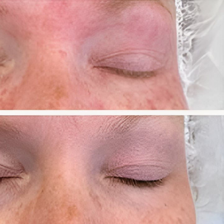 Behandling af Perioral dermatitis