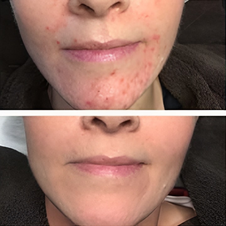 Behandling af Perioral dermatitis