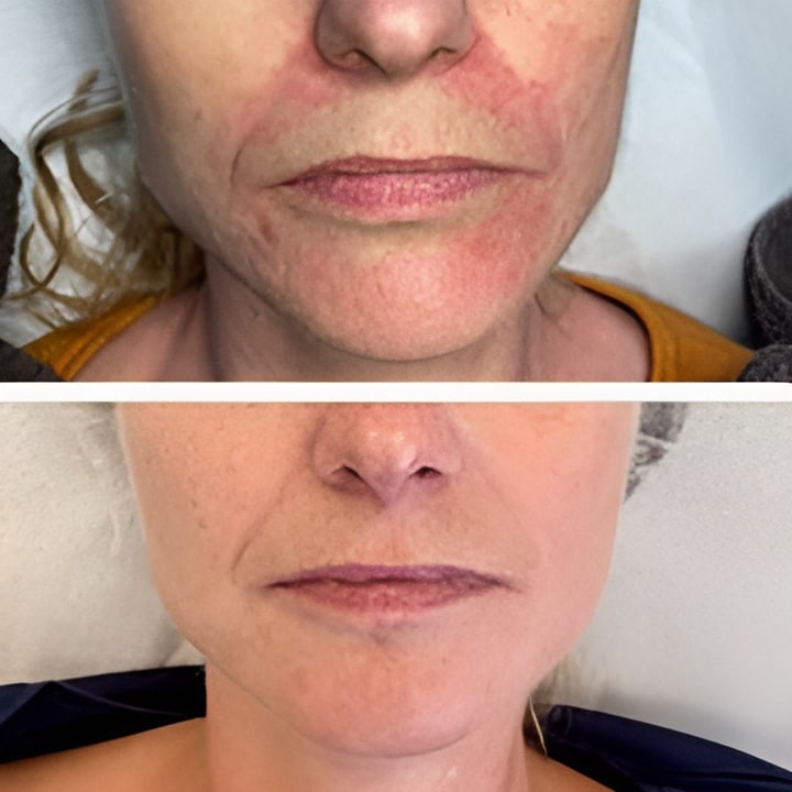 Behandling af Perioral dermatitis