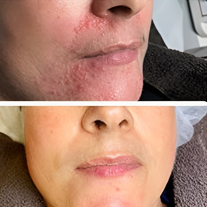 Behandling af Perioral dermatitis