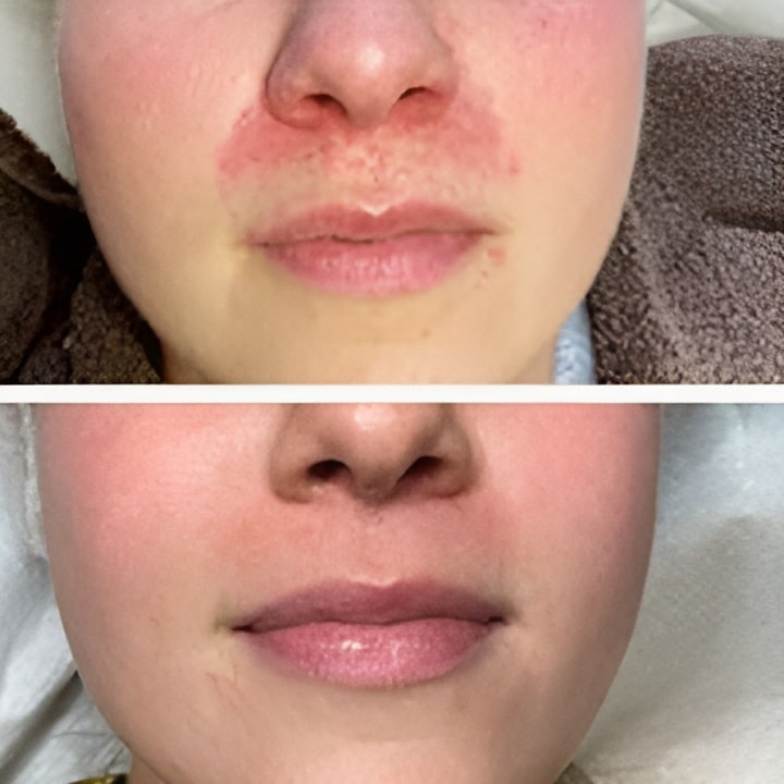Behandling af Perioral dermatitis