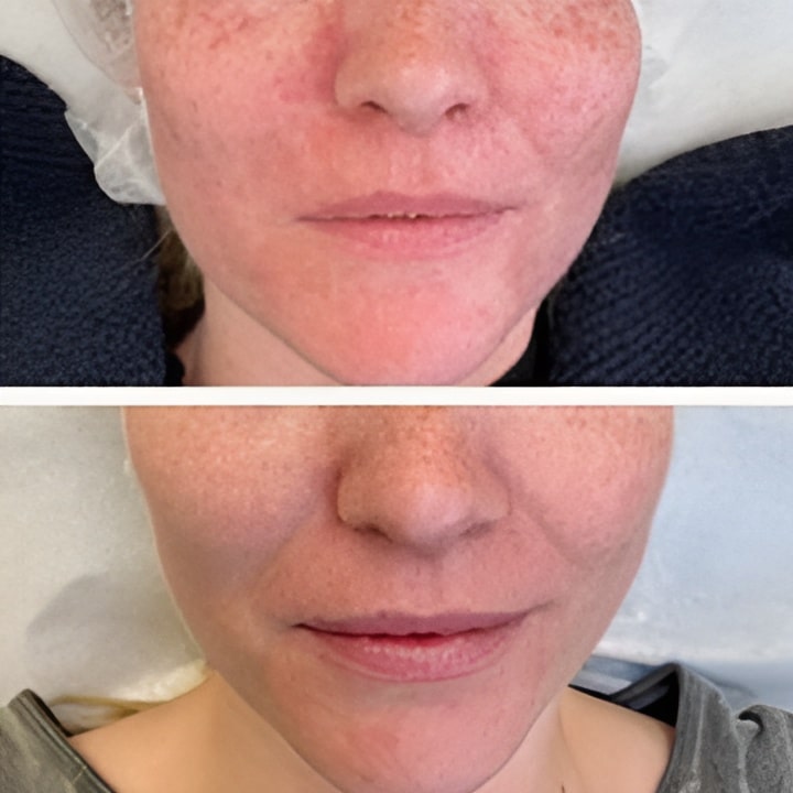 Behandling af Perioral dermatitis