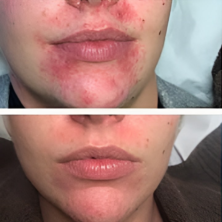 Behandling af Perioral dermatitis