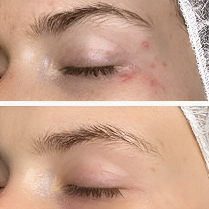 Behandling af Perioral dermatitis