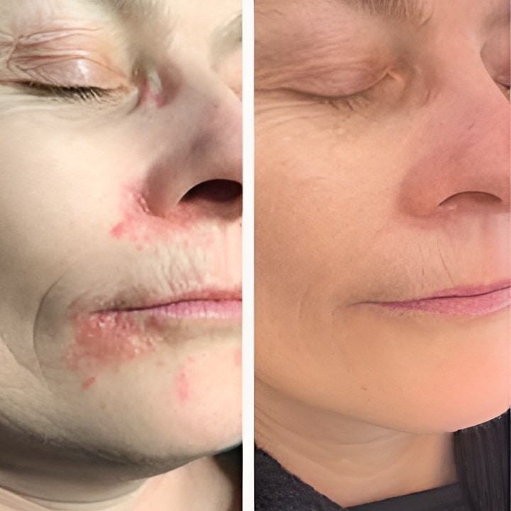 Behandling af Perioral dermatitis