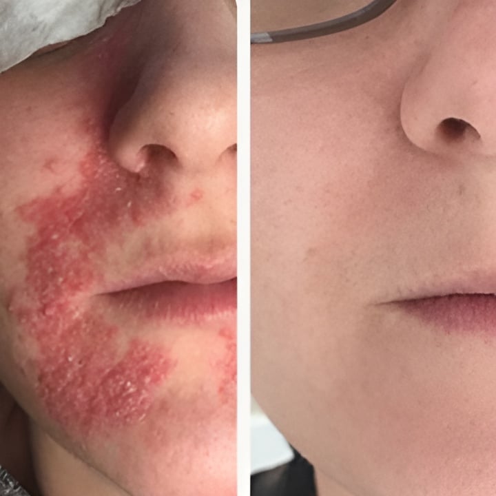 Behandling af Perioral dermatitis