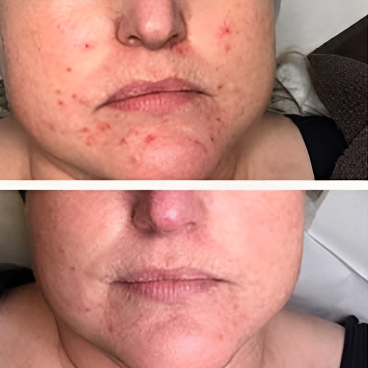 Behandling af Perioral dermatitis