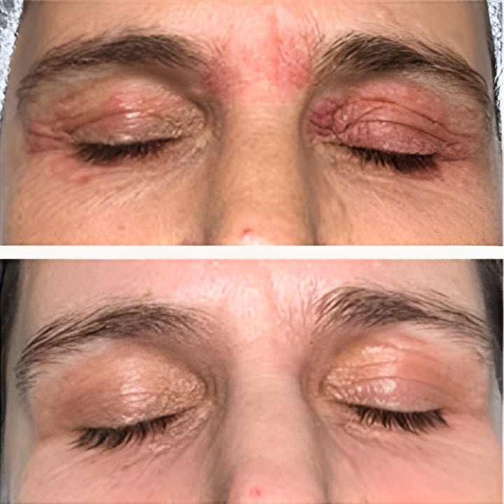 Behandling af Perioral dermatitis