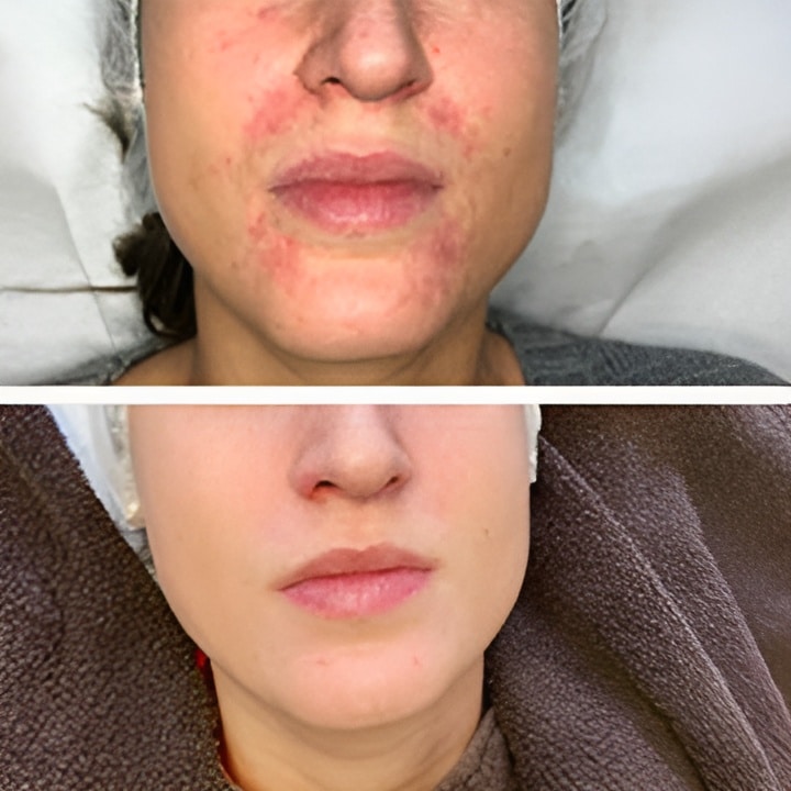 Behandling af Perioral dermatitis