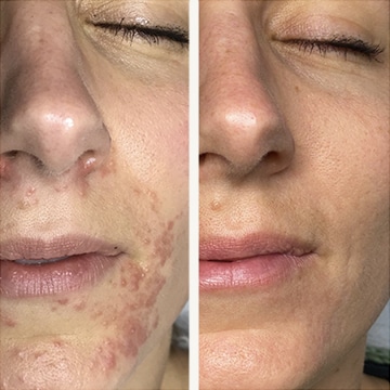 Behandling af Perioral dermatitis