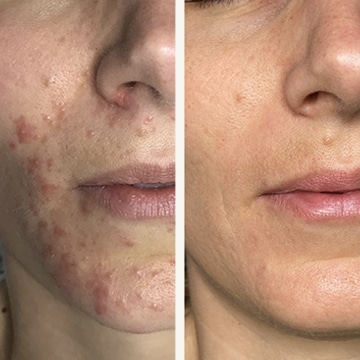 Behandling af Perioral dermatitis