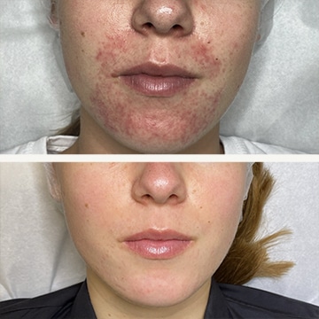 Behandling af Perioral dermatitis