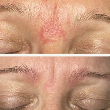Behandling af Perioral dermatitis