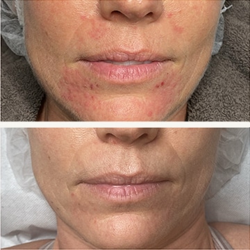 Behandling af Perioral dermatitis