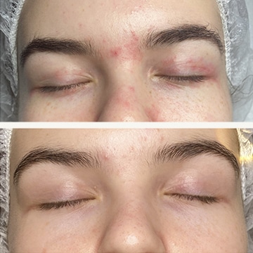 Behandling af Perioral dermatitis