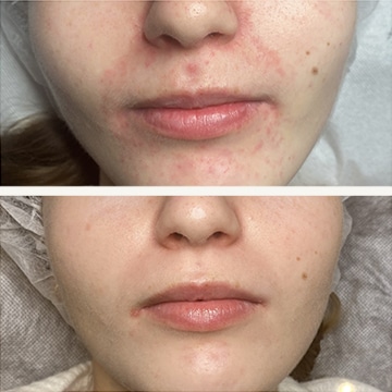 Behandling af Perioral dermatitis