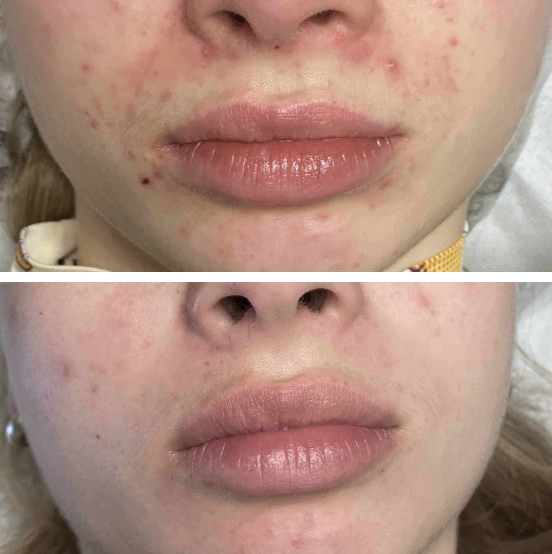 Behandling af Perioral dermatitis