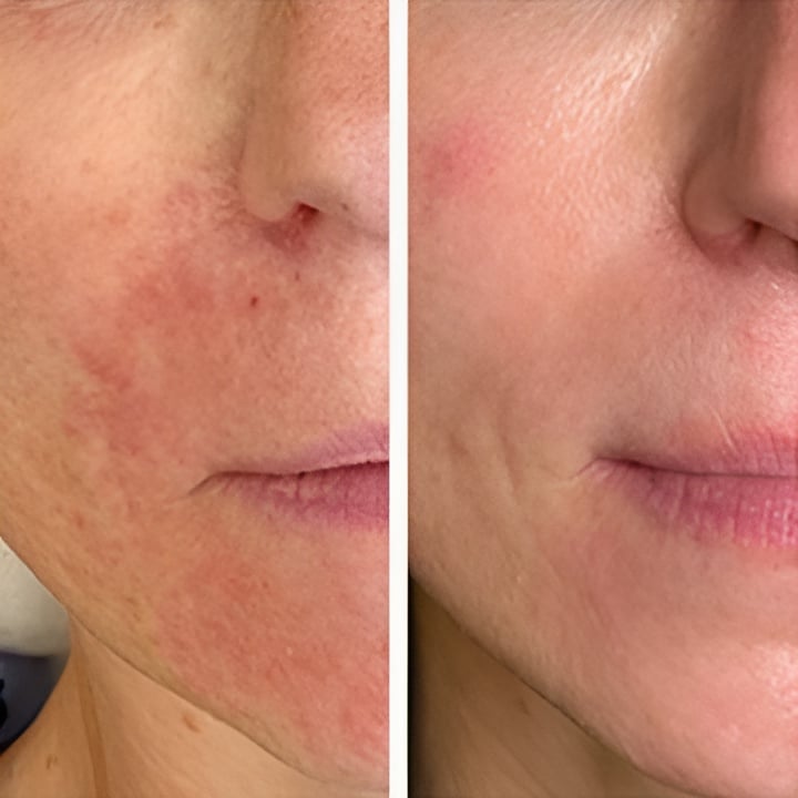 Perioral dermatitis - før & efter Behandlingsforløb