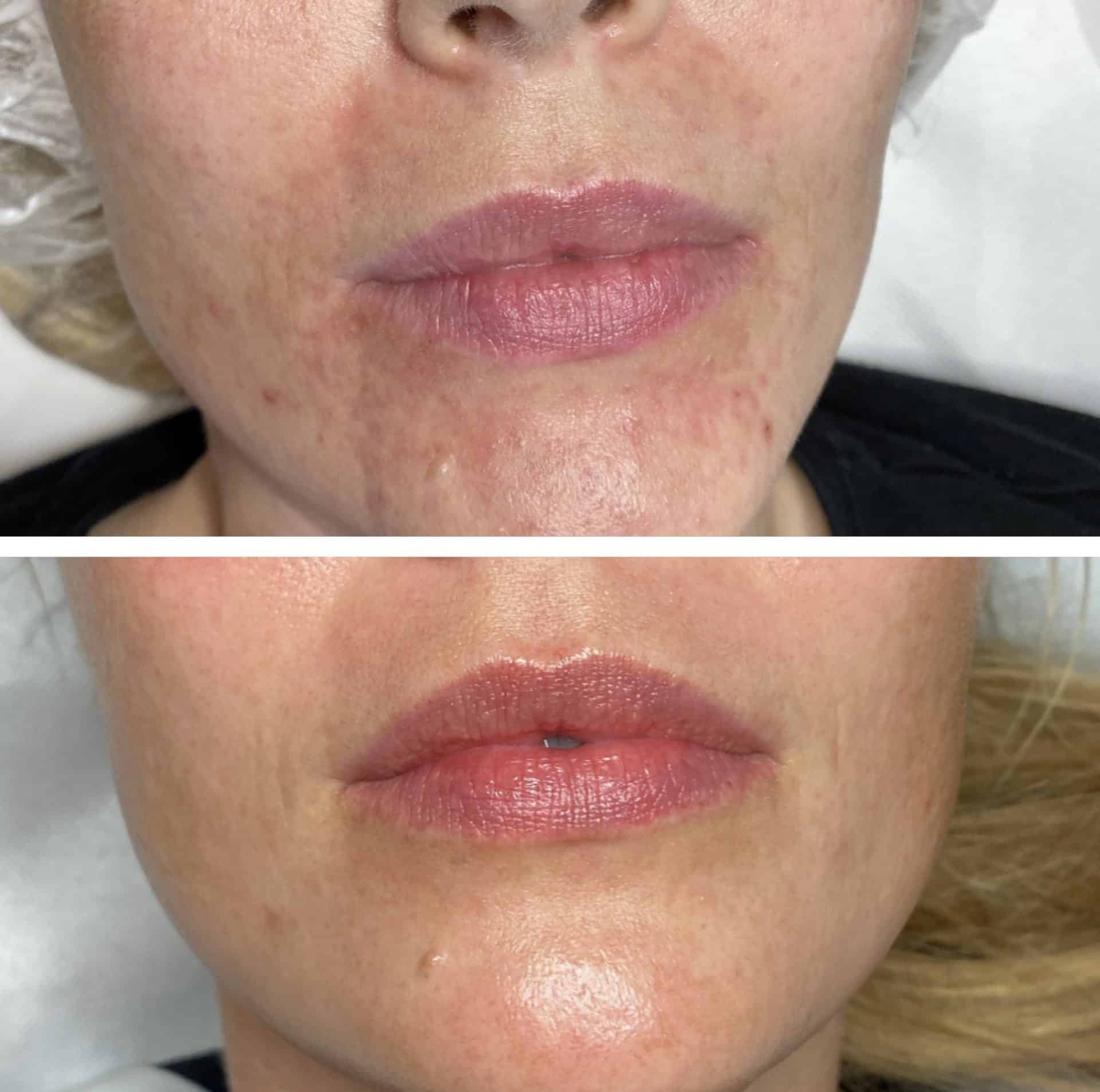 Behandling af Perioral dermatitis