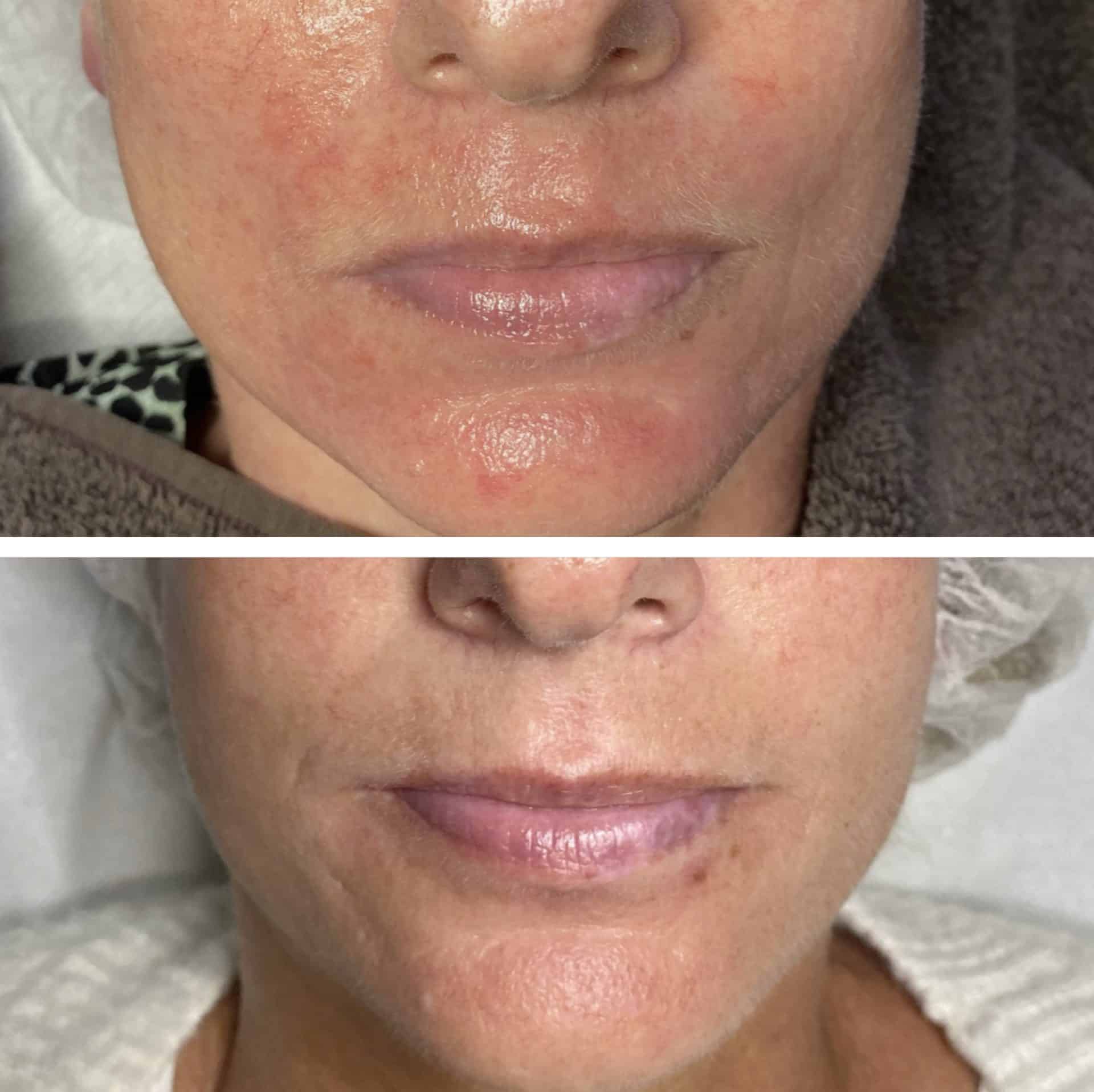 Behandling af Perioral dermatitis