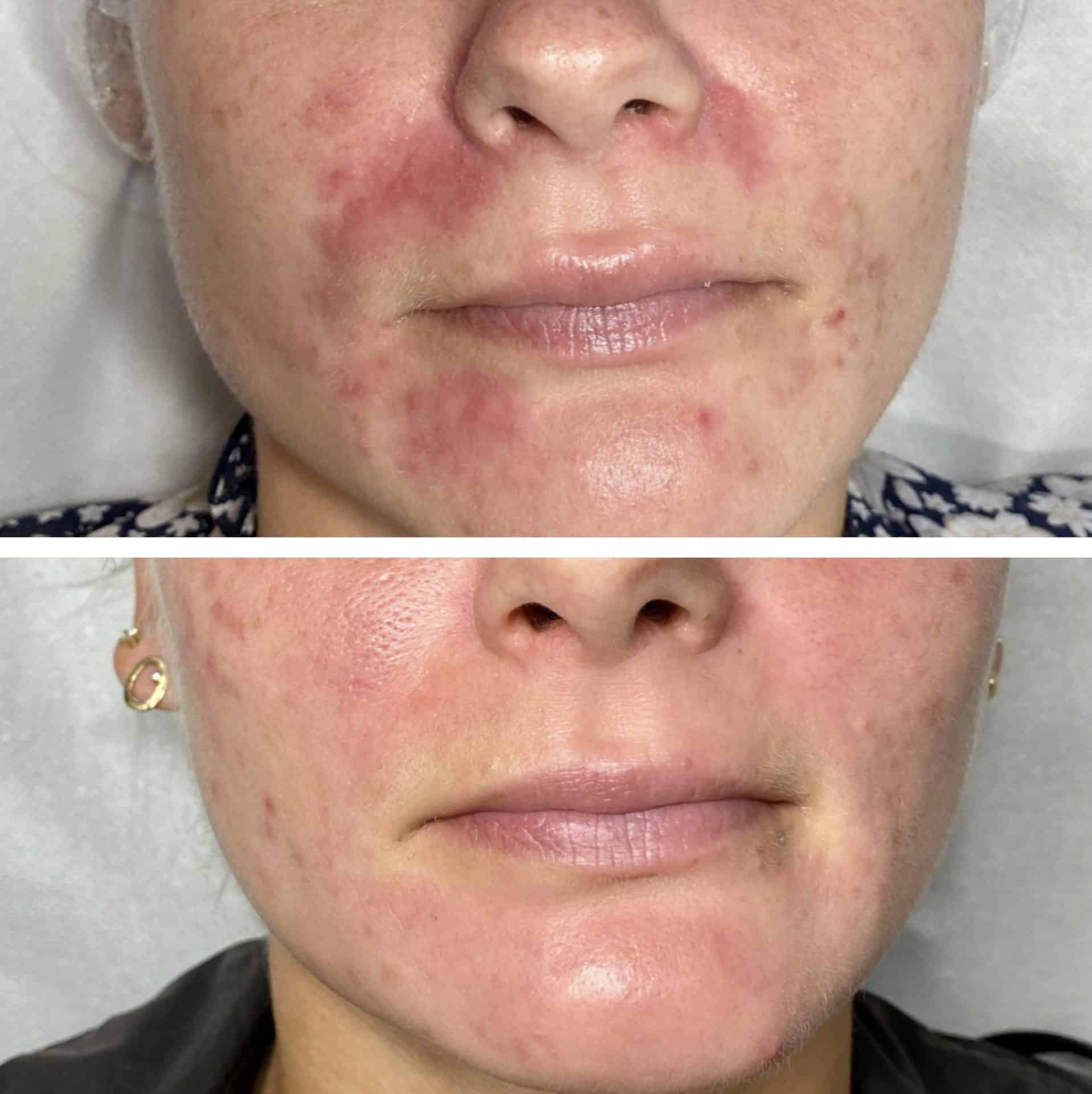 Behandling af Perioral dermatitis