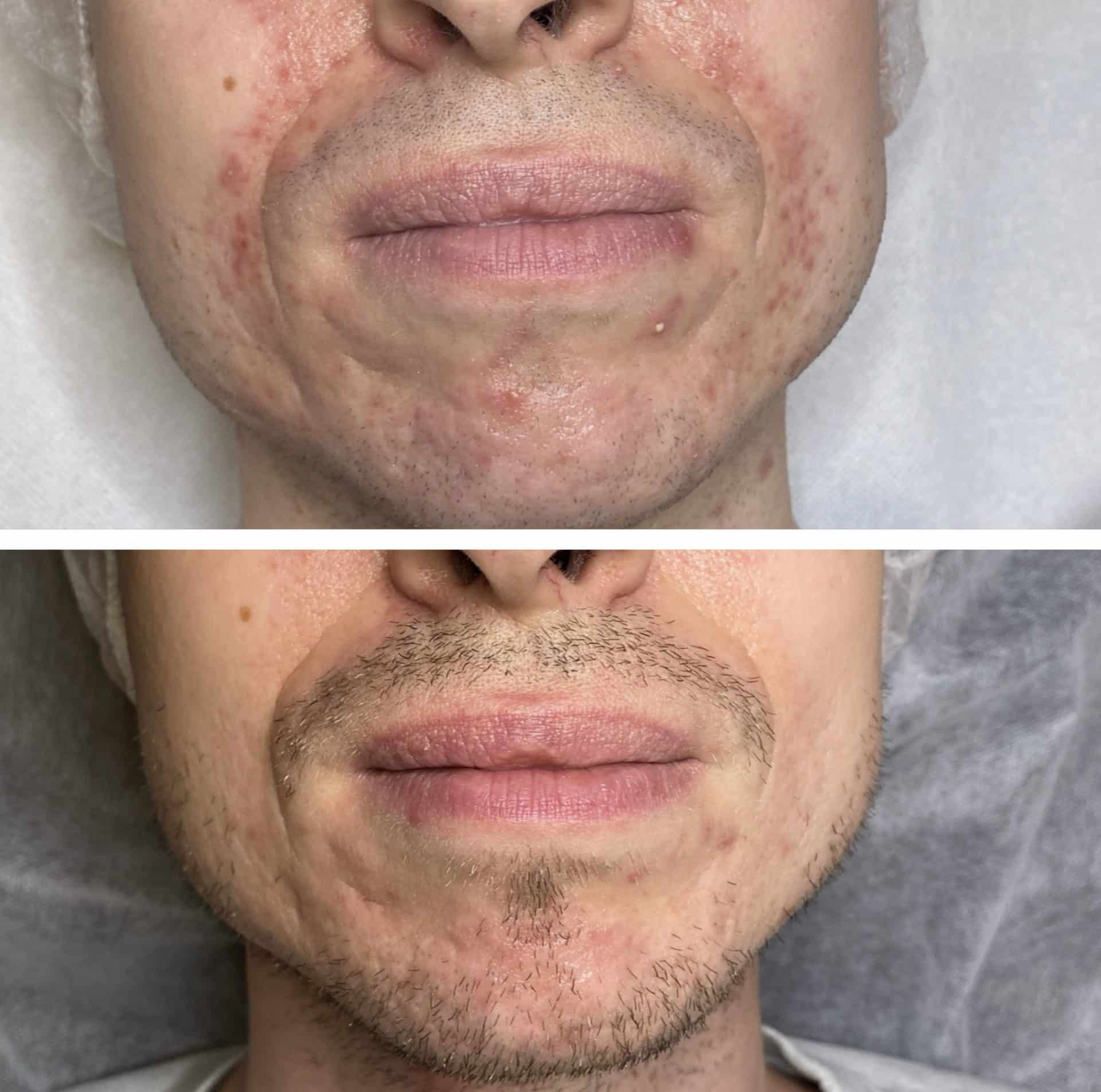 Behandling af Perioral dermatitis