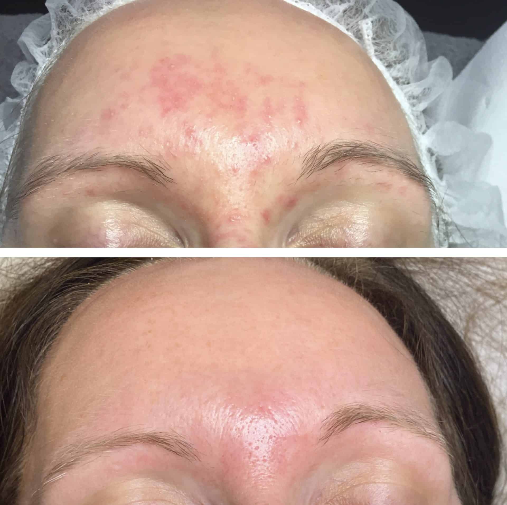 Behandling af Perioral dermatitis