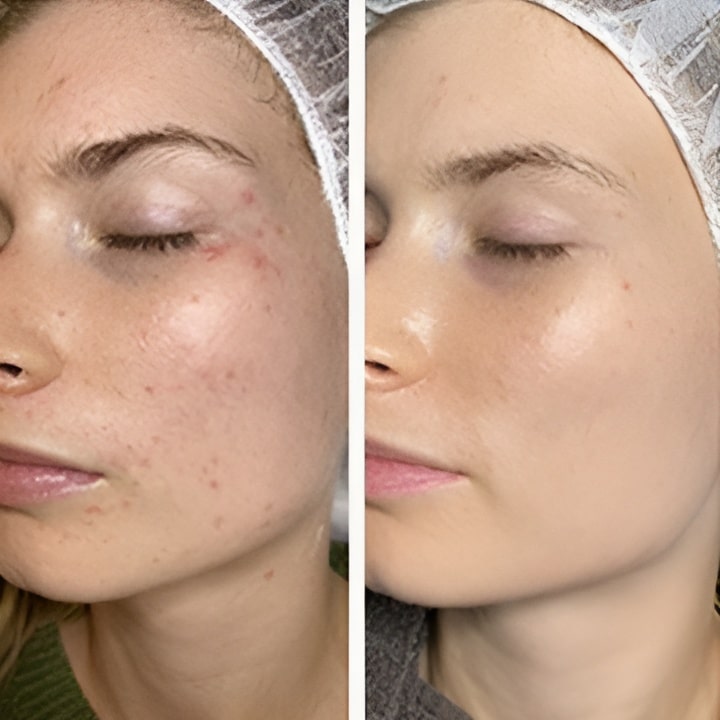Perioral dermatitis - før & efter Behandlingsforløb