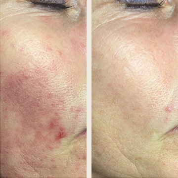 Behandling af Rosacea